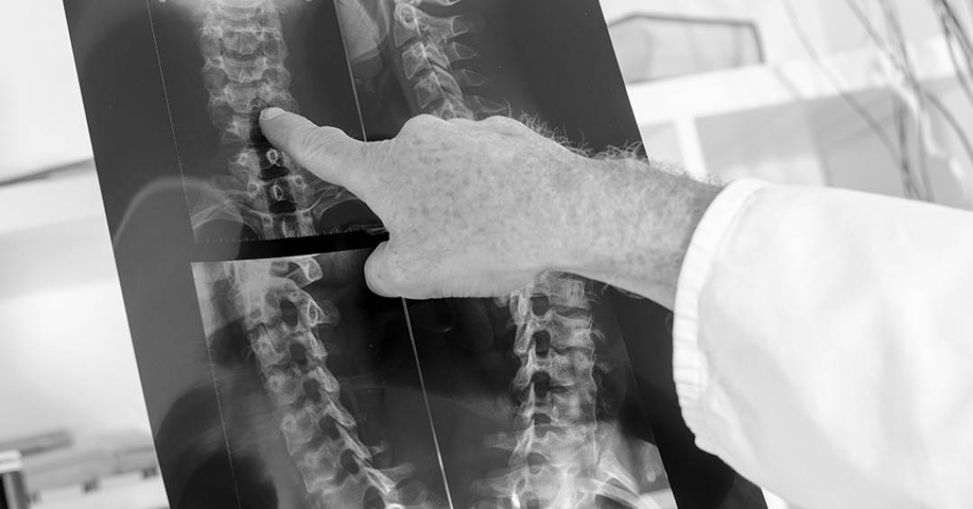 Como funciona o medicamento brasileiro que pode ajudar a recuperar movimentos após lesões na medula